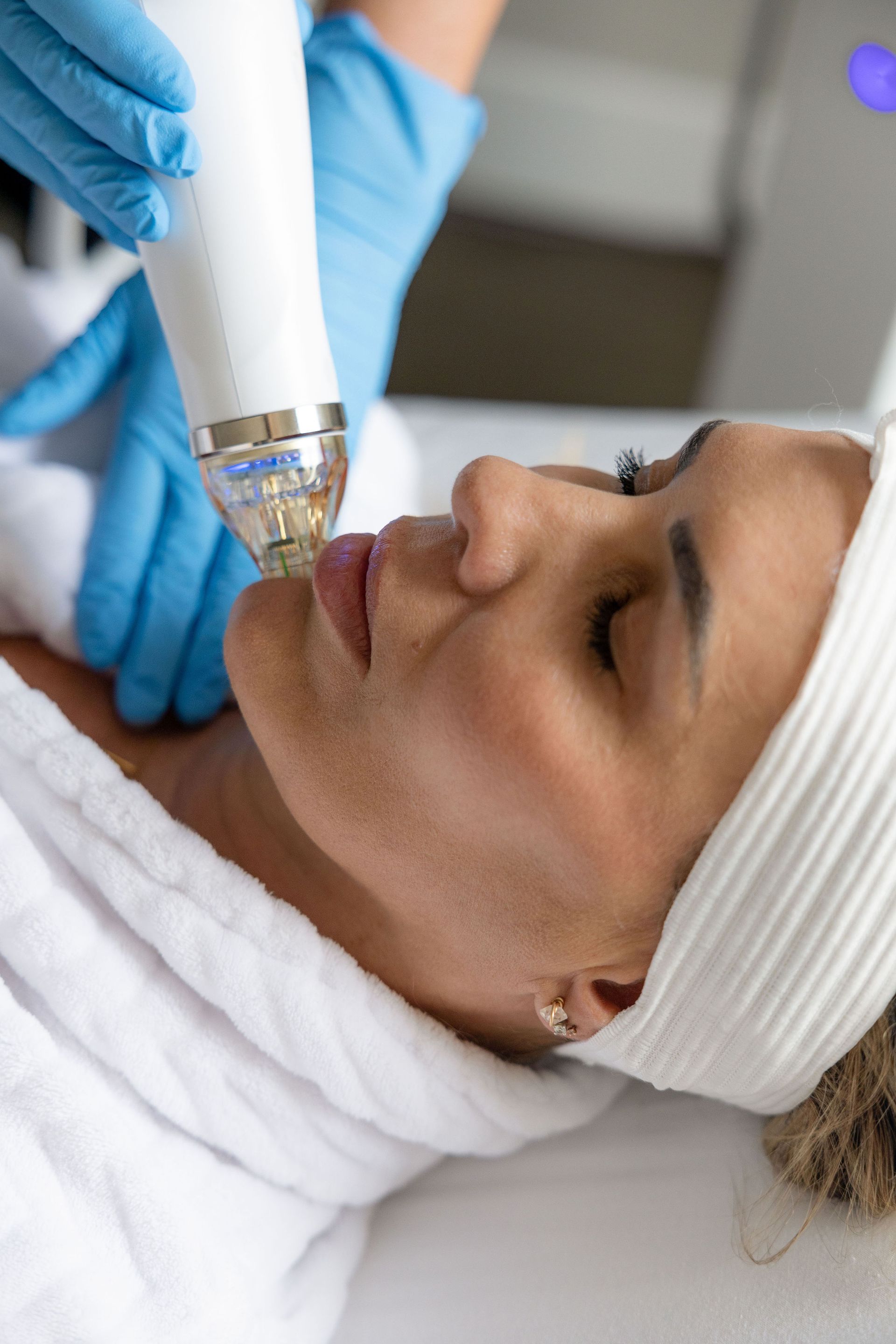 Woman getting secret rf microneedling