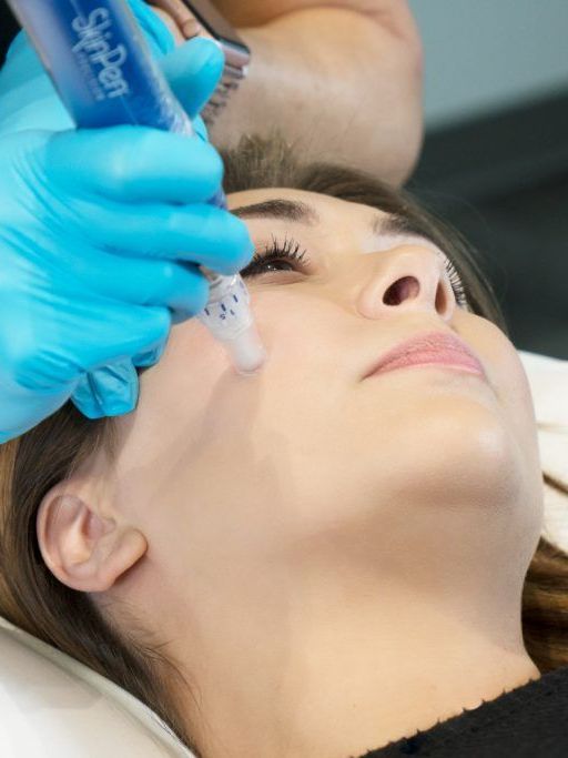 skin pen microneedling treatment