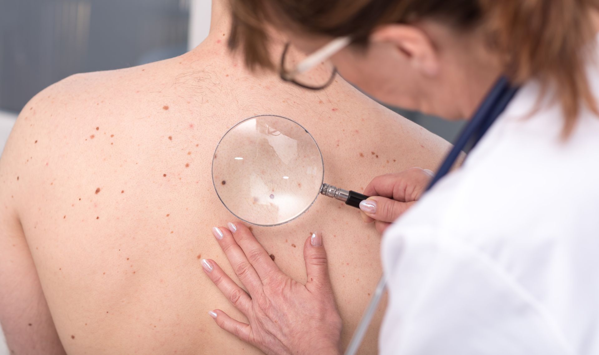 A dermatologist is using a magnifying glass to examine moles on a patient's back