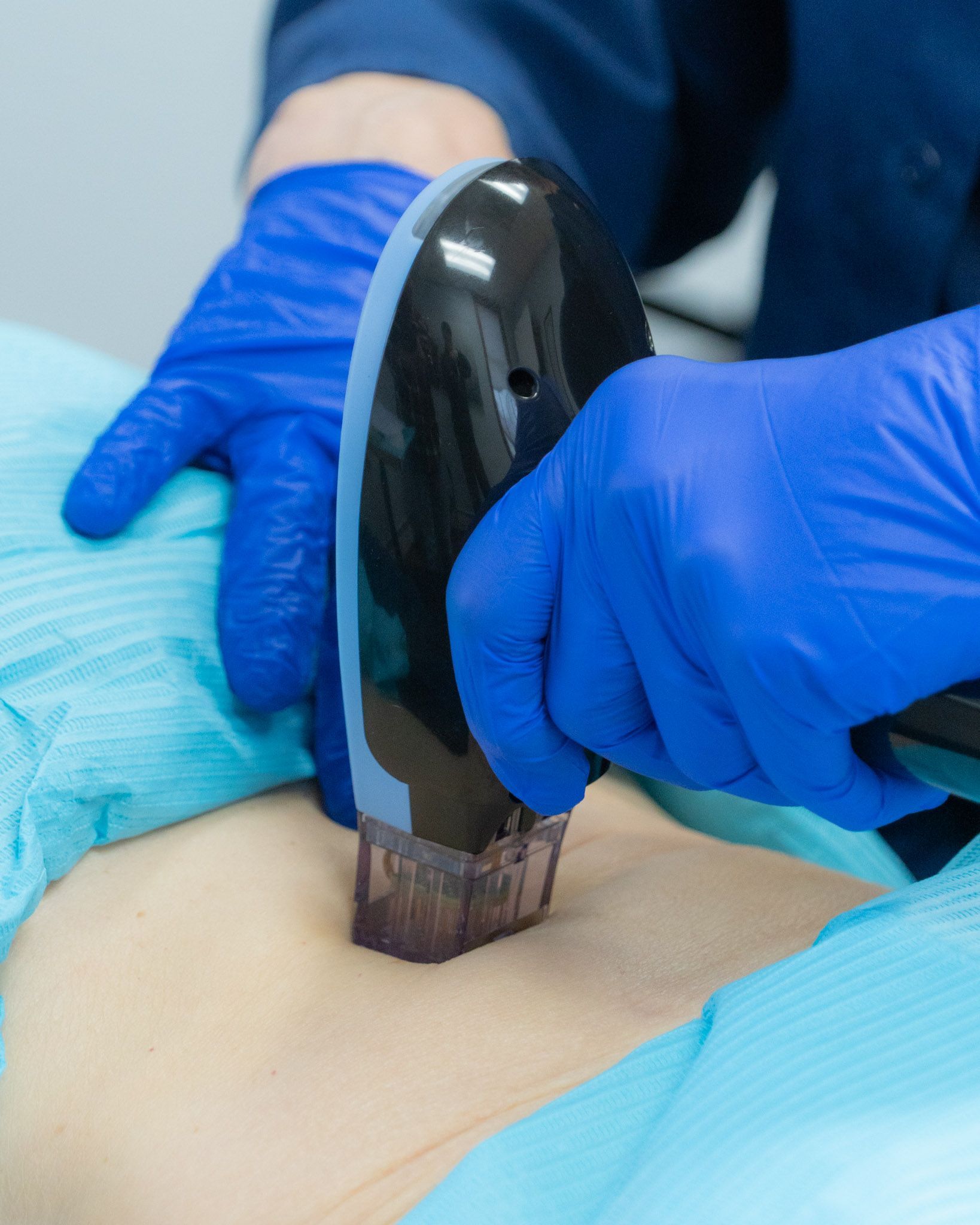 Hands in blue gloves holding device to patient's abdomen, possibly for a medical procedure.