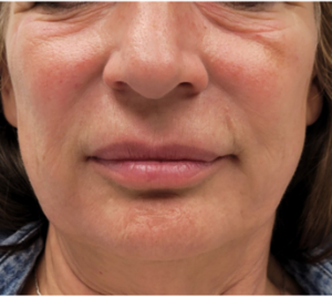 Close-up of a person's face; showing nose, mouth, wrinkles, and slight redness on skin.