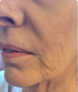Close-up of a person's face showing signs of aging, including wrinkles around the mouth and on the cheek.