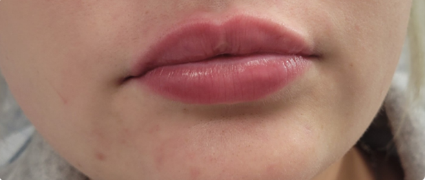 Close-up of a person's lips. The lips are full, with a pinkish hue. The skin around the mouth is fair.