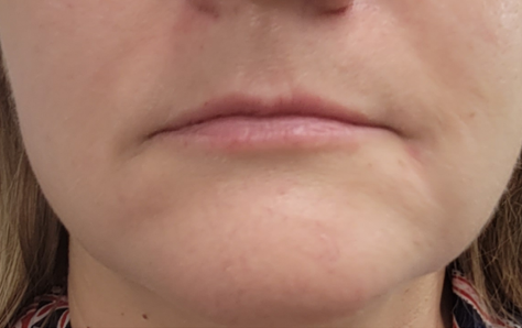 Close-up of a person's lower face, showing lips, chin, and skin.