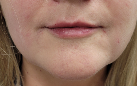 Close-up of a person's lower face, focusing on the lips and chin; visible skin redness.