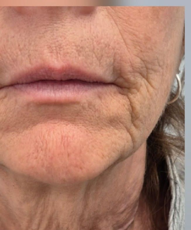 Close-up of lower face showing lips and chin with visible wrinkles and skin texture.