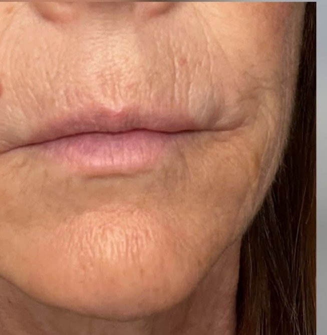 Close-up of a person's mouth and chin, showing fine lines and wrinkles on the skin.