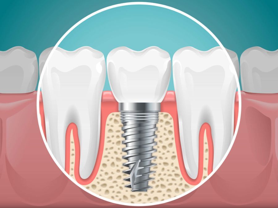 Figura di un impianto dentale