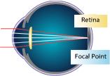aspheric correction visual