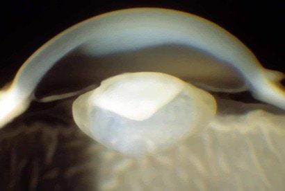 cataract