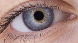 glaucoma