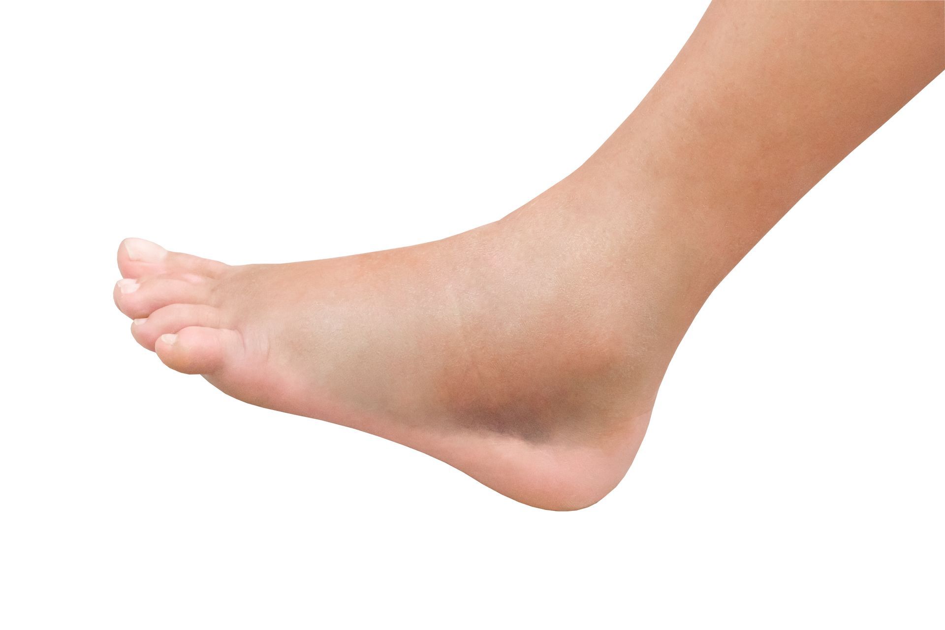A close-up view of a human foot, showing a swollen ankle against a white background.