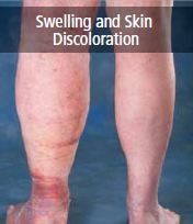 swelling and discoloration