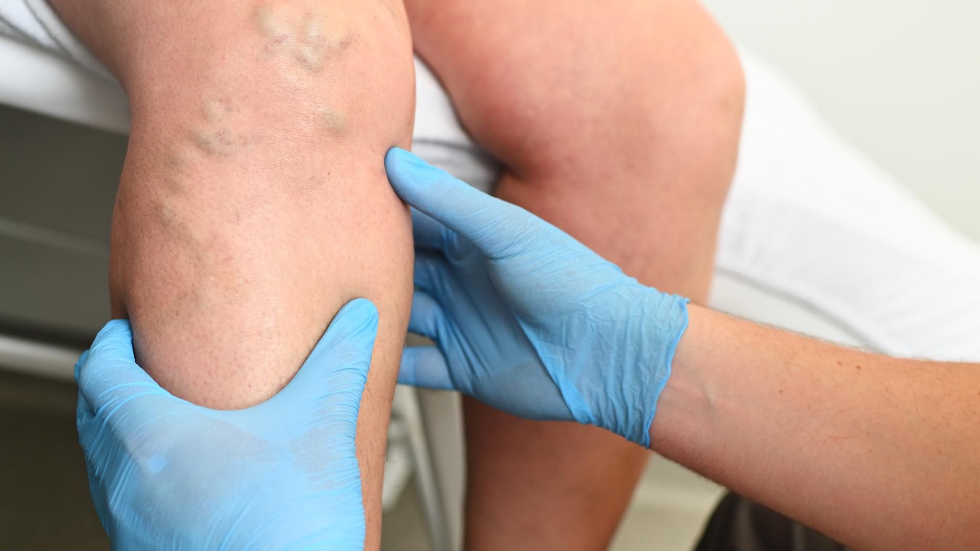 Gloved hands examining a person's knee and thigh on a medical exam table