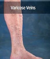 varicose veins
