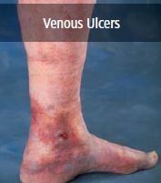 venous ulcers