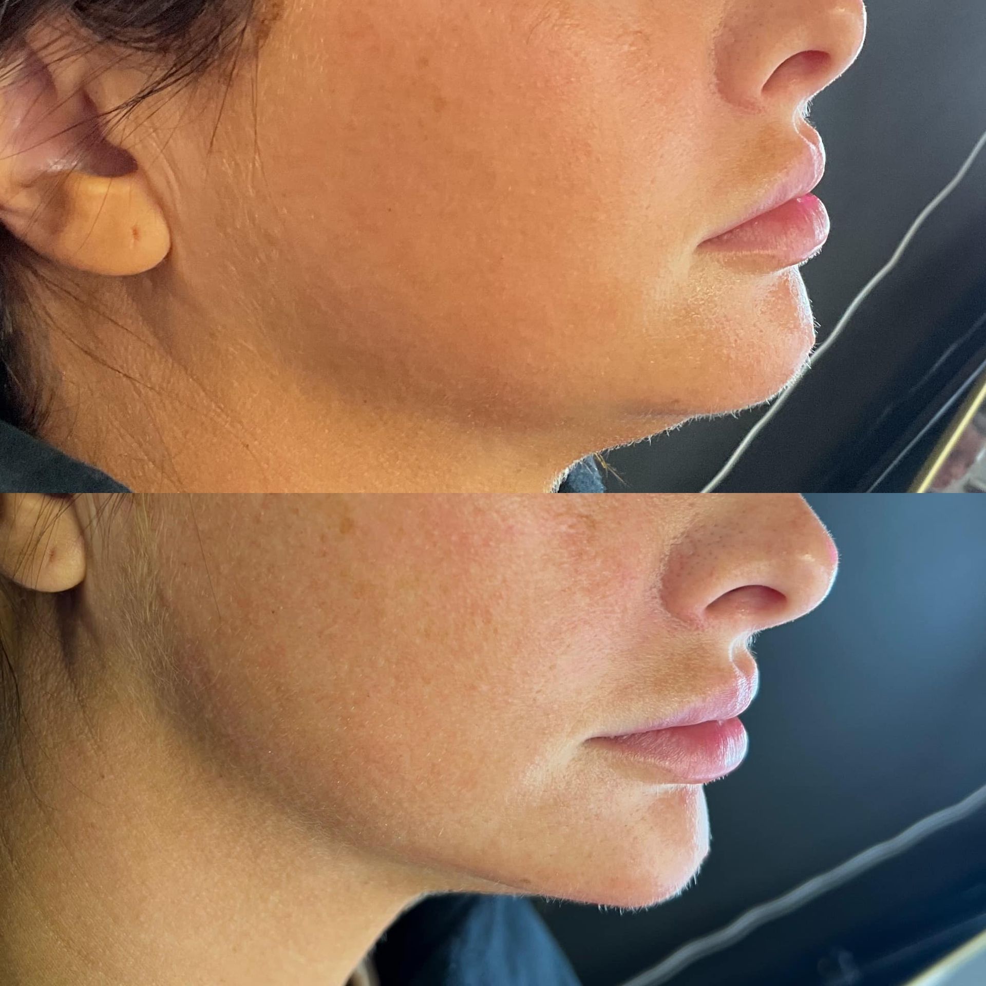 Before and after jawline enhancement results from a professional med spa treatment in Battlefield, MO.