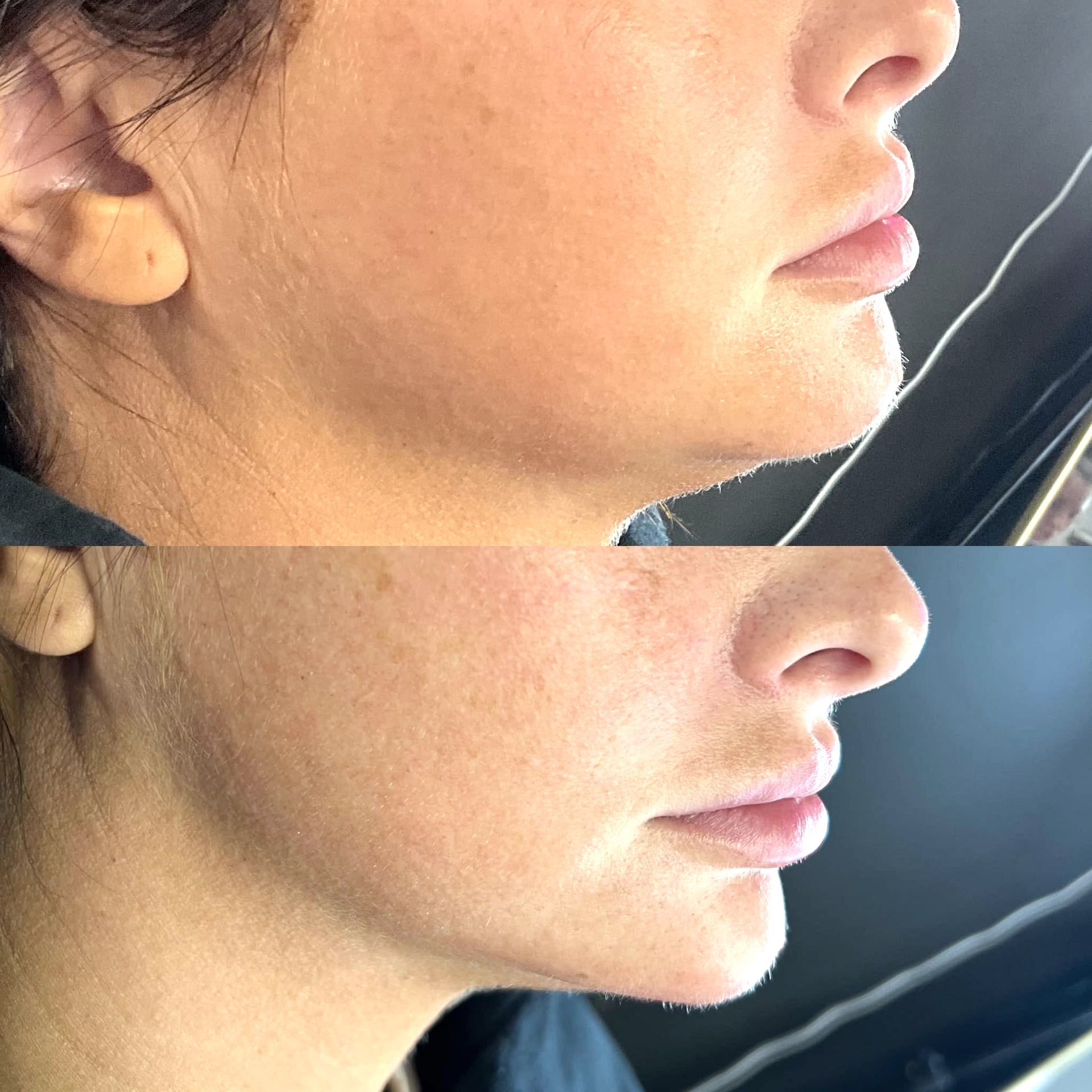 Before and after jawline contouring results from a professional aesthetic treatment in Nixa, MO.