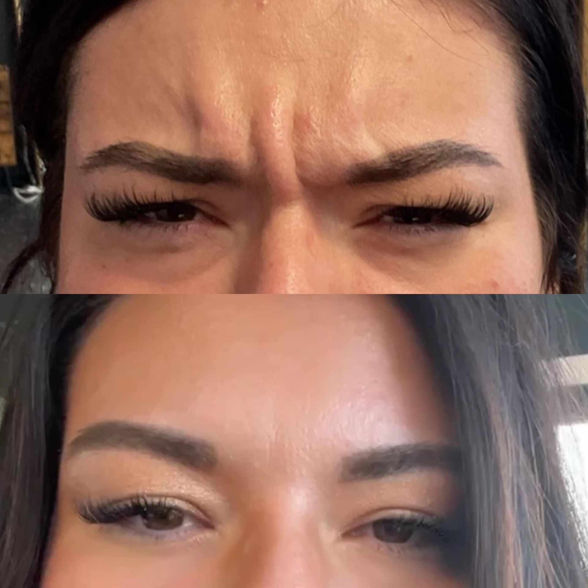 Before and after Botox treatment showing reduced frown lines between the brows in Willard, MO.