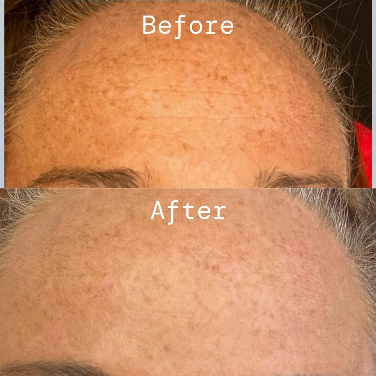 Before and after Botox treatment showing smoother forehead lines in Brookline, MO.