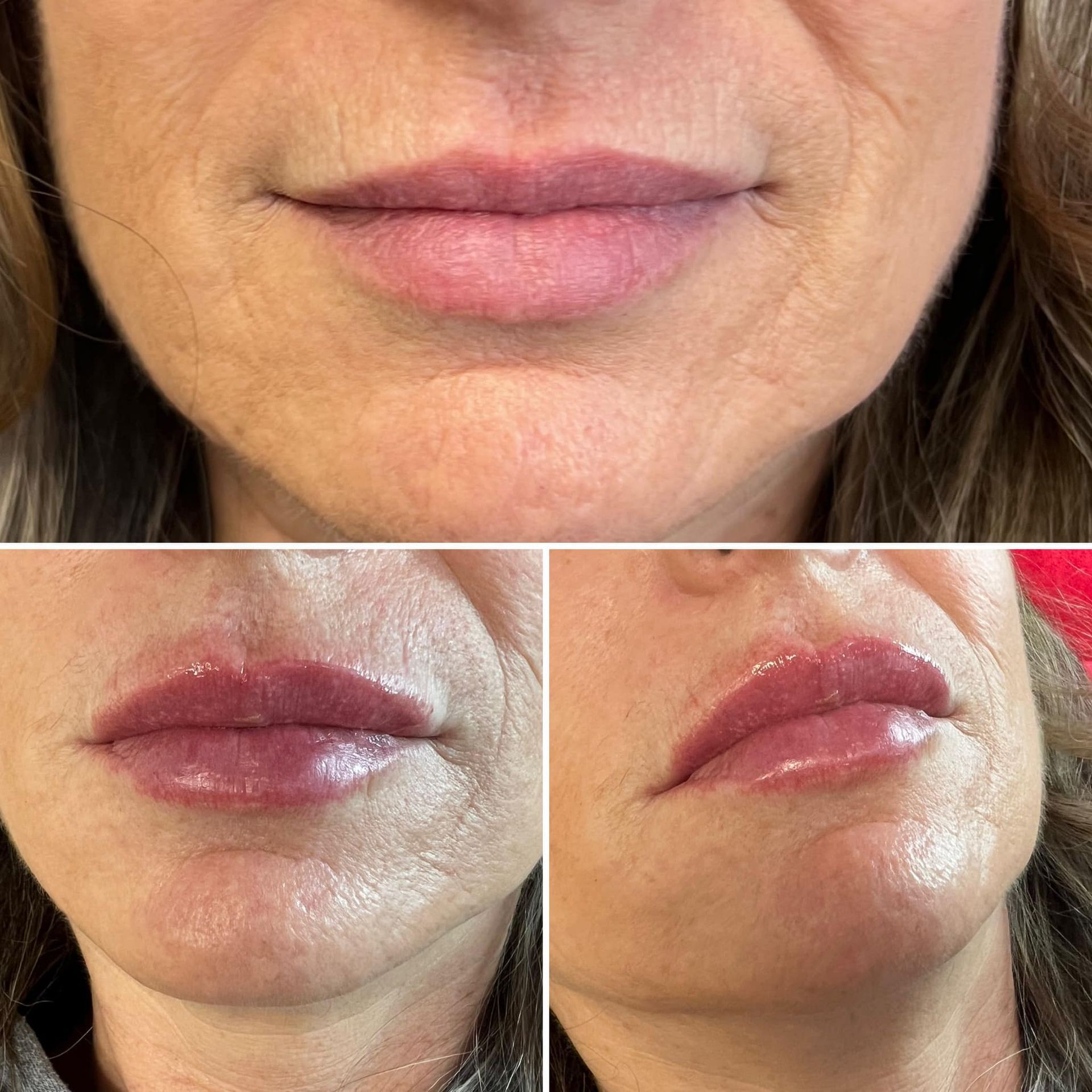 Before and after lip filler treatment showing fuller, more defined lips in Battlefield, MO.