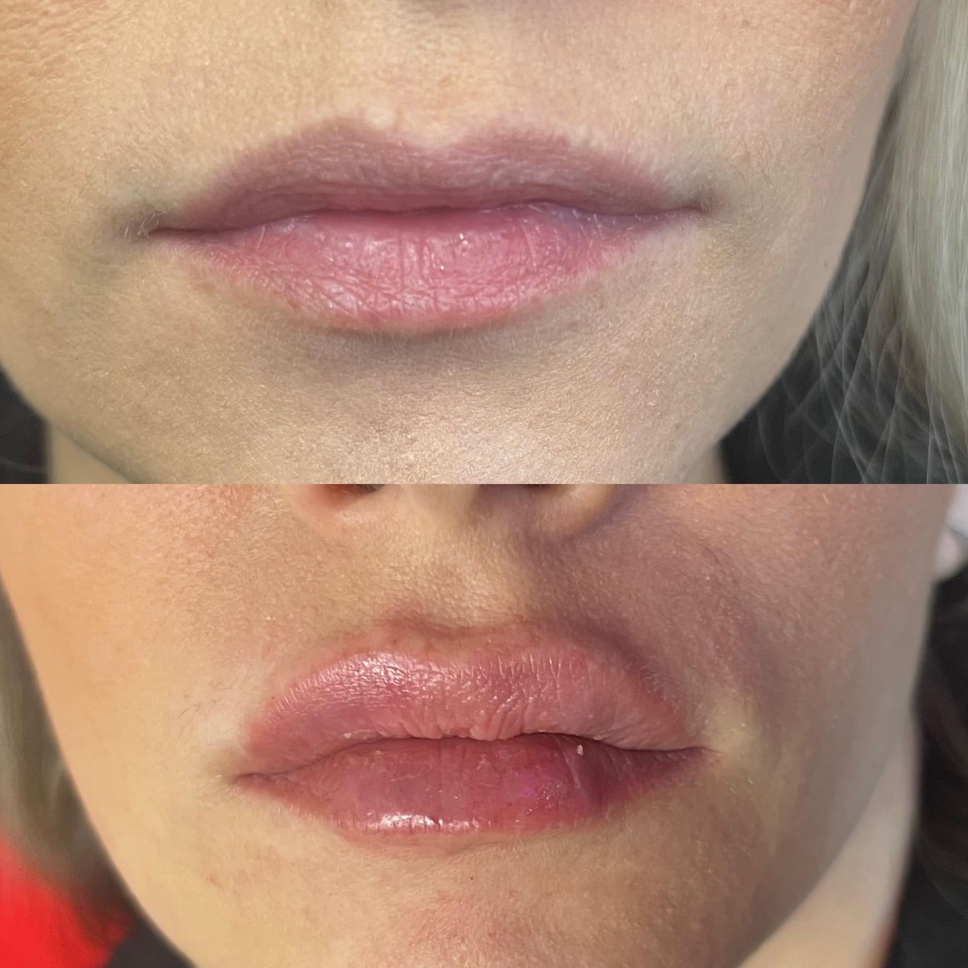 Before and after lip filler results showing enhanced lip shape and volume in Ozark, MO.
