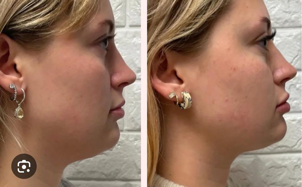 Before and after facial profile enhancement results from a professional med spa in Springfield, MO.