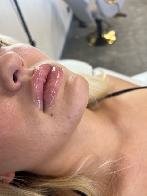 Professional lip filler treatment results for enhanced lip shape and volume in Marshfield, MO.