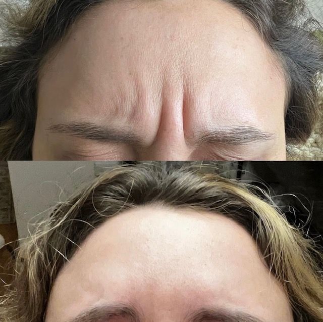 Before and after Botox treatment showing reduced forehead lines and wrinkles in Rogersville, MO.