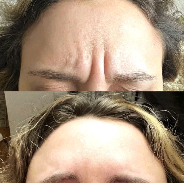 Before and after Botox results showing reduced forehead and frown lines in Willard, MO.