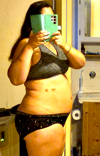 Bariatric Weight Loss Surgery Liverpool, NSW & Kogarah