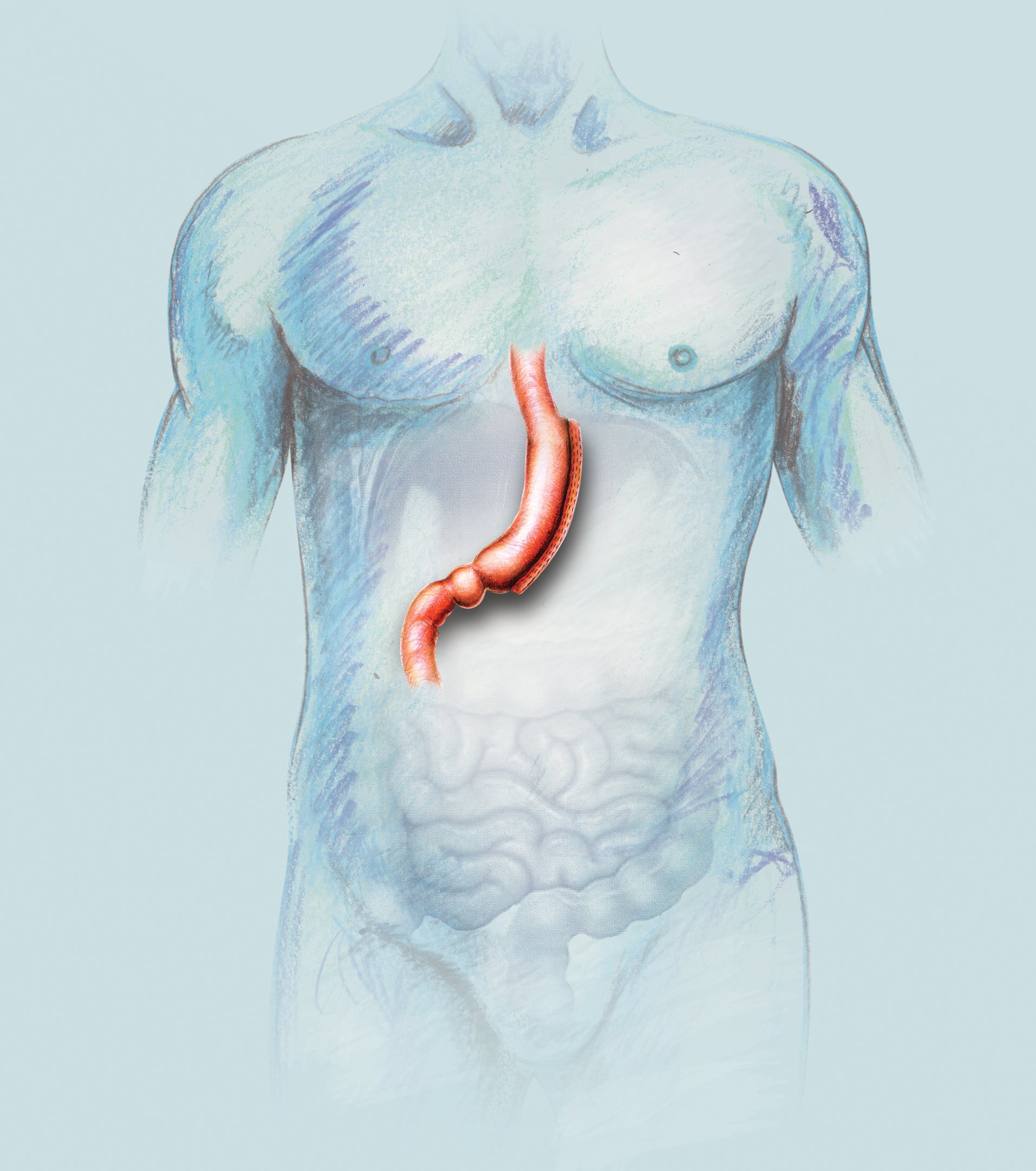 Best Gastric Sleeve Surgeon Sydney