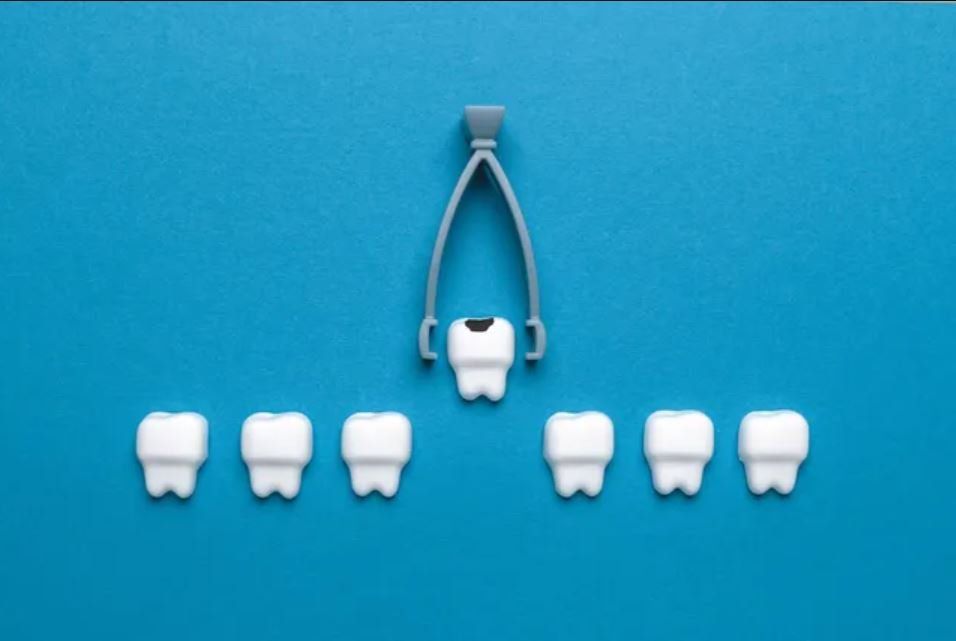 Tooth extraction