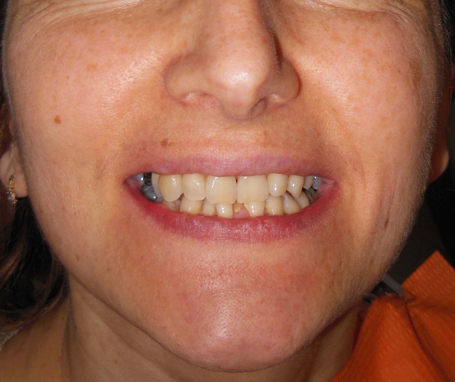 Primo piano di una persona sorridente che mostra uno spazio tra gli incisivi superiori e un dente blu sul lato sinistro
