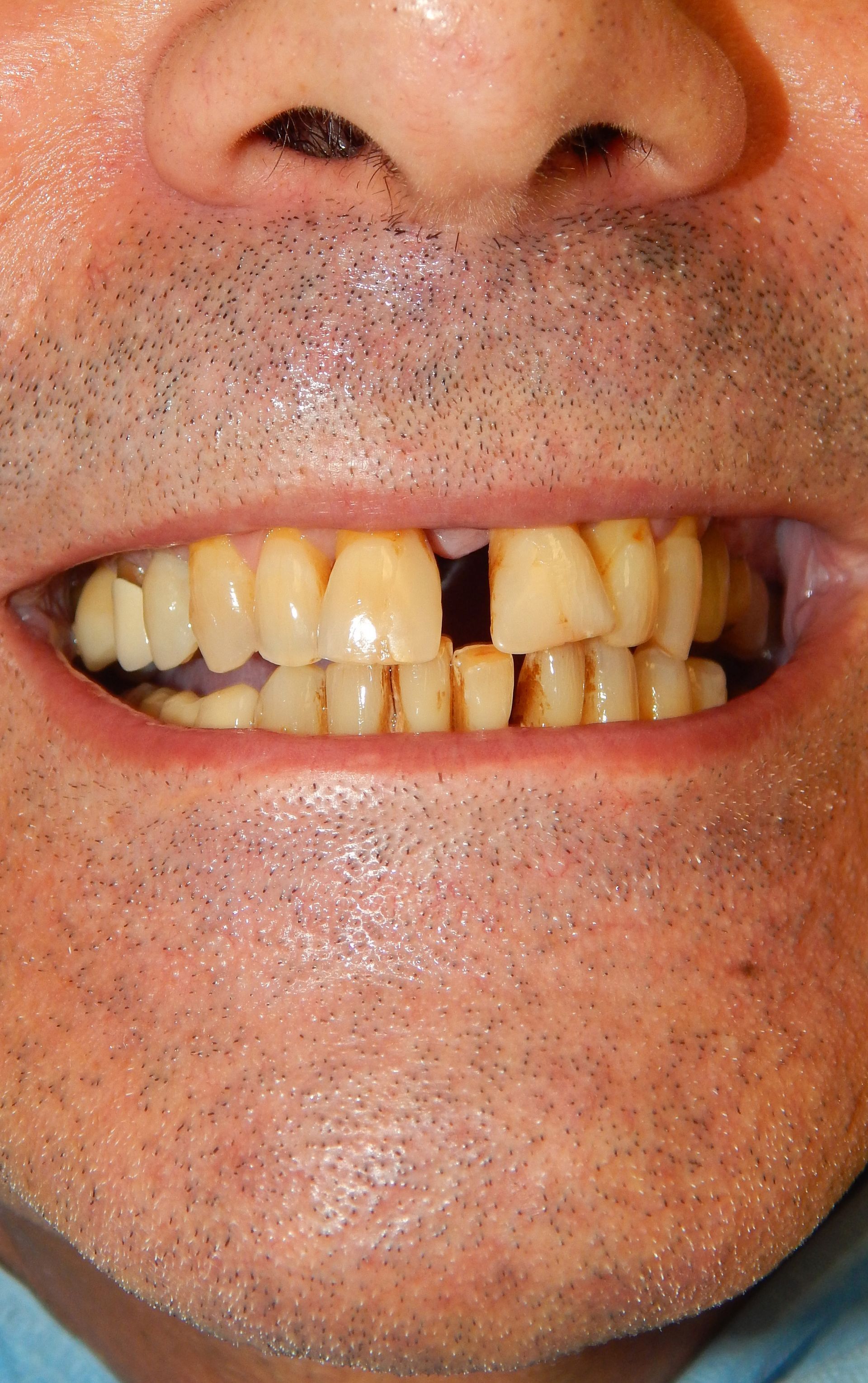 Primo piano della bocca di un uomo, con i denti anteriori superiori storti e mancanti