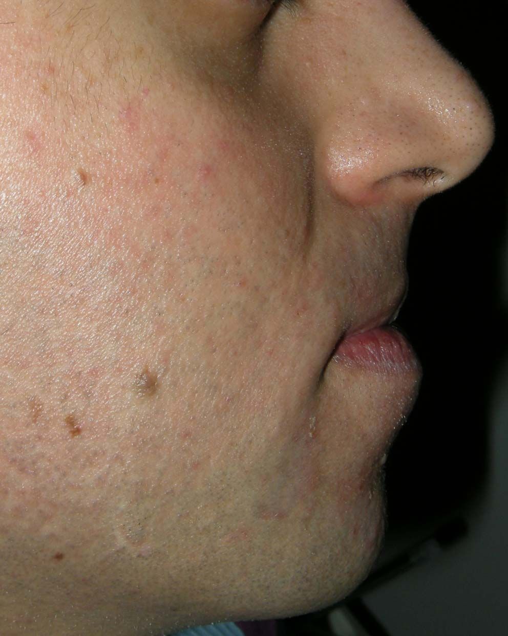 Profilo laterale del viso di una persona, con imperfezioni della pelle visibili sulla guancia e lungo la mandibola