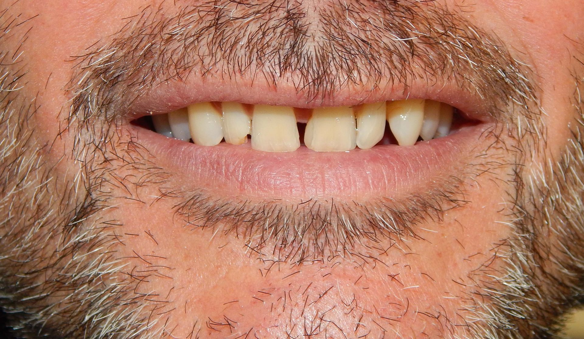 Primo piano di una bocca sorridente con denti irregolari e ingialliti e barba incolta sul viso