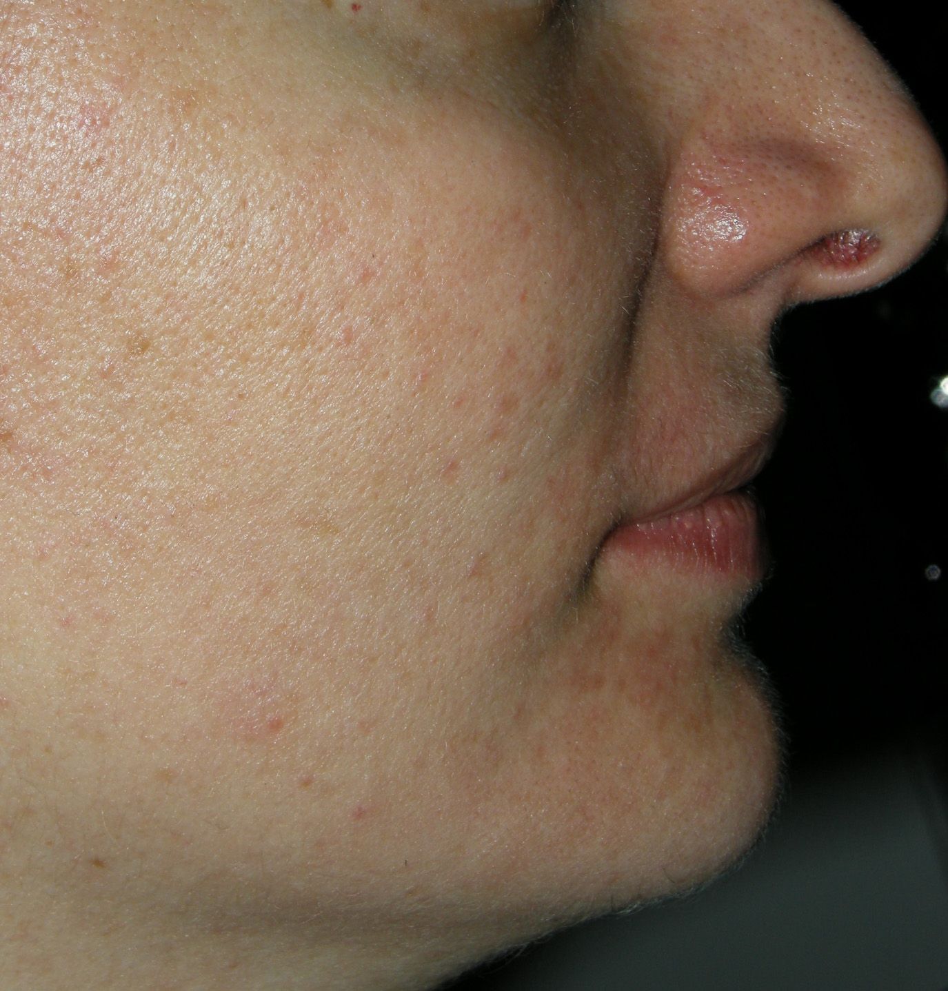 Profilo laterale del volto di una persona, con un piercing al naso ben visibile e imperfezioni della pelle, su uno sfondo scuro