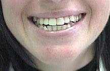 Primo piano di una bocca sorridente che mostra i denti, incorniciata da capelli scuri