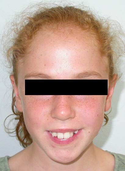 Ritratto ravvicinato di un bambino sorridente con una barra nera sugli occhi