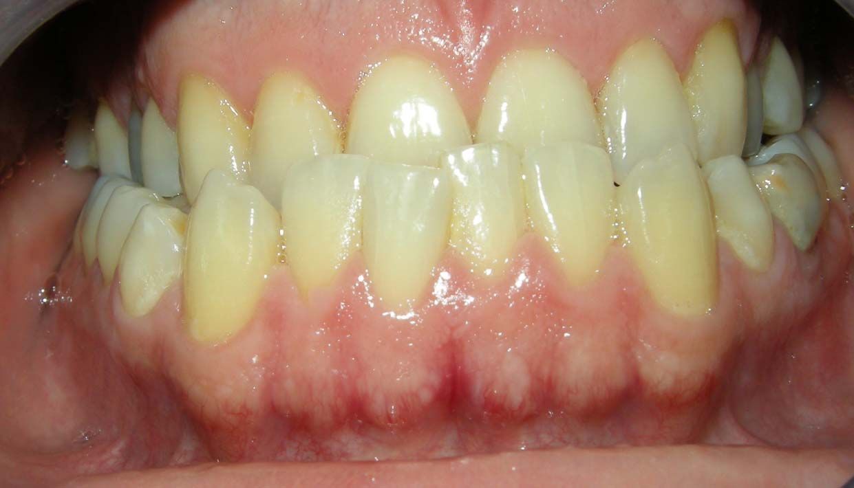 Primo piano di denti serrati con macchie gialle visibili e gengive arrossate e irritate
