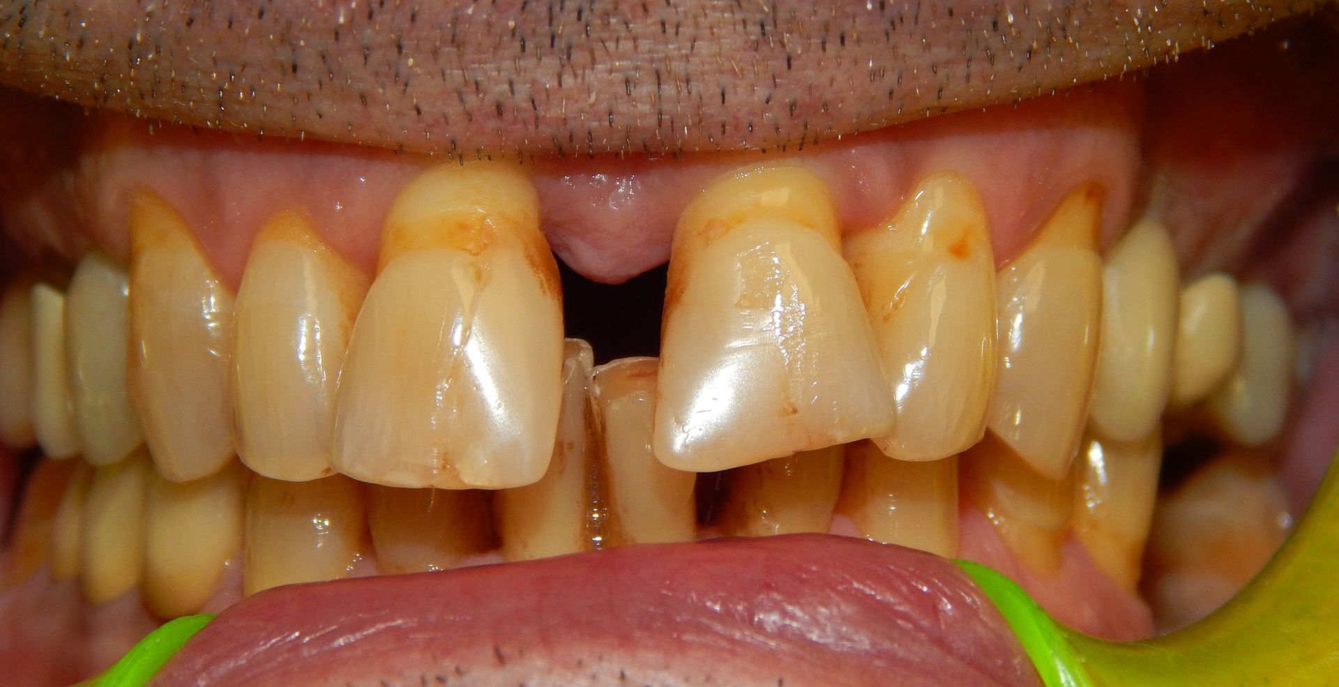 Primo piano degli incisivi superiori sporgenti, con discromia dentale e disallineamento