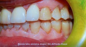 Primo piano laterale dei denti con incisivi superiori e inferiori disallineati, su uno sfondo giallo da modello dentale