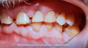 Primo piano della bocca aperta di un bambino, con i denti anteriori disallineati e le gengive rosa.