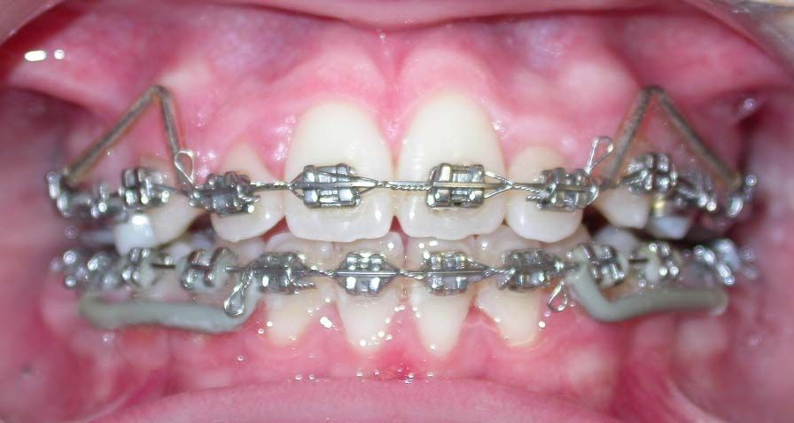 Primo piano dei denti con apparecchio ortodontico metallico e divaricatore labiale durante il trattamento ortodontico