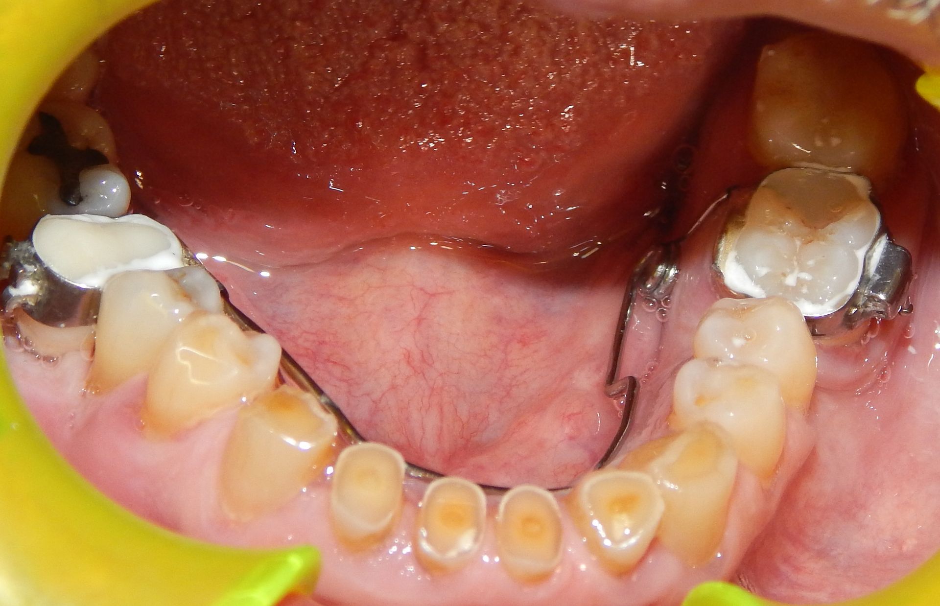 Bocca aperta con i denti inferiori visibili, apparecchi ortodontici e otturazioni metalliche, vista dal basso