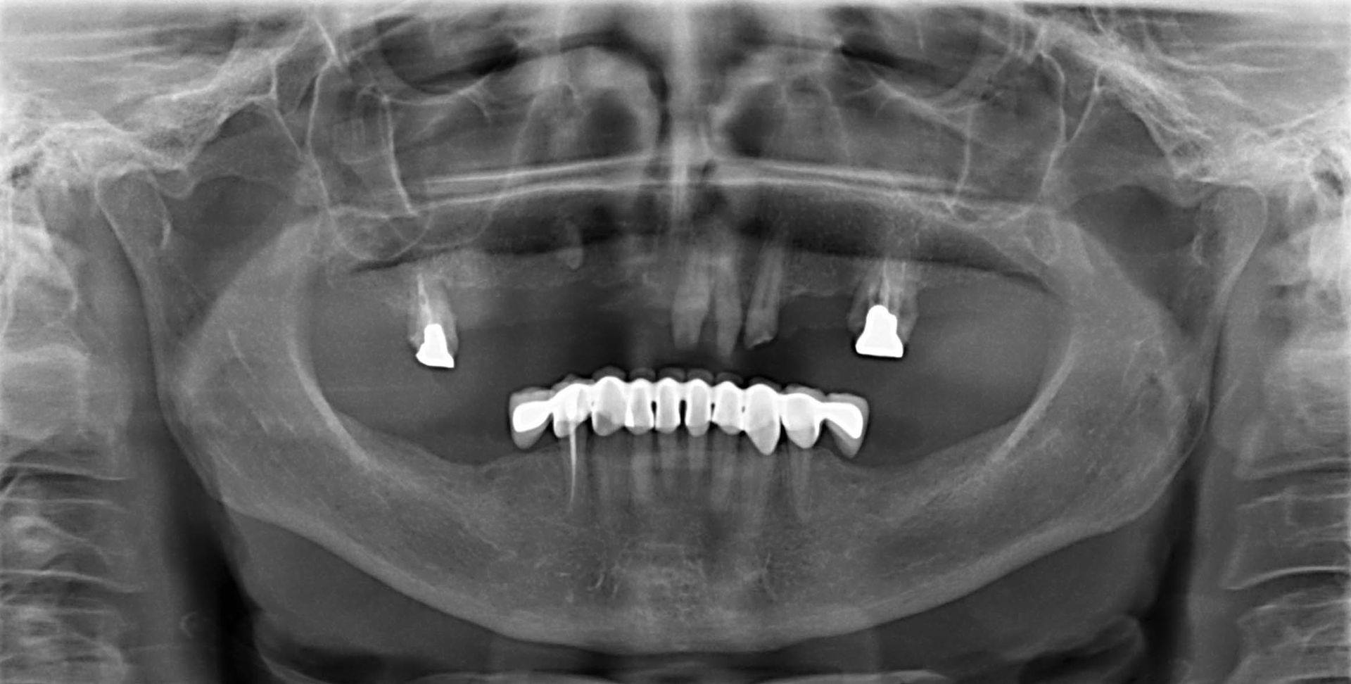 Radiografia panoramica dentale che mostra la mandibola, i denti e diversi impianti dentali con un ponte.