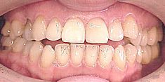 Primo piano di denti con un evidente spazio tra gli incisivi e un allineamento irregolare