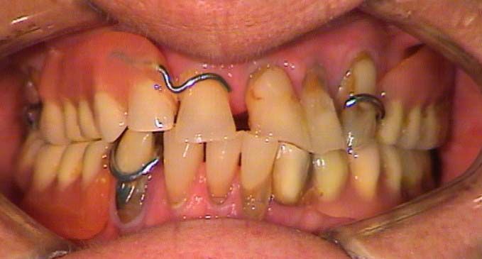 Primo piano di denti con apparecchio ortodontico ed elastici, che mostra i denti anteriori affollati e le gengive rosa