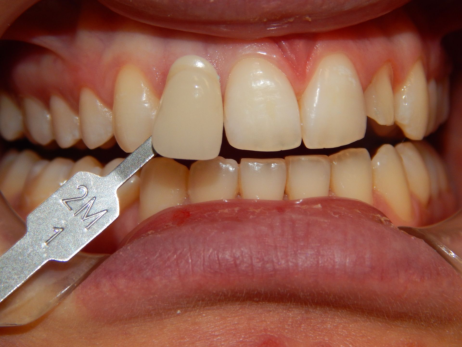 Bocca aperta con i denti inferiori visibili, apparecchi ortodontici e otturazioni metalliche, vista dal basso